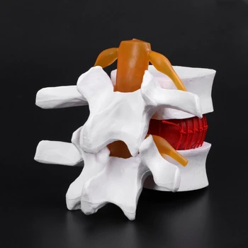 Анатомическая модел херния на лумбалните диск на човек Медицински обучителен инструмент за изучаване на анатомия
